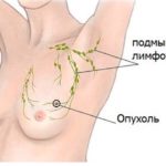 опухоль