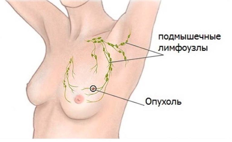 опухоль