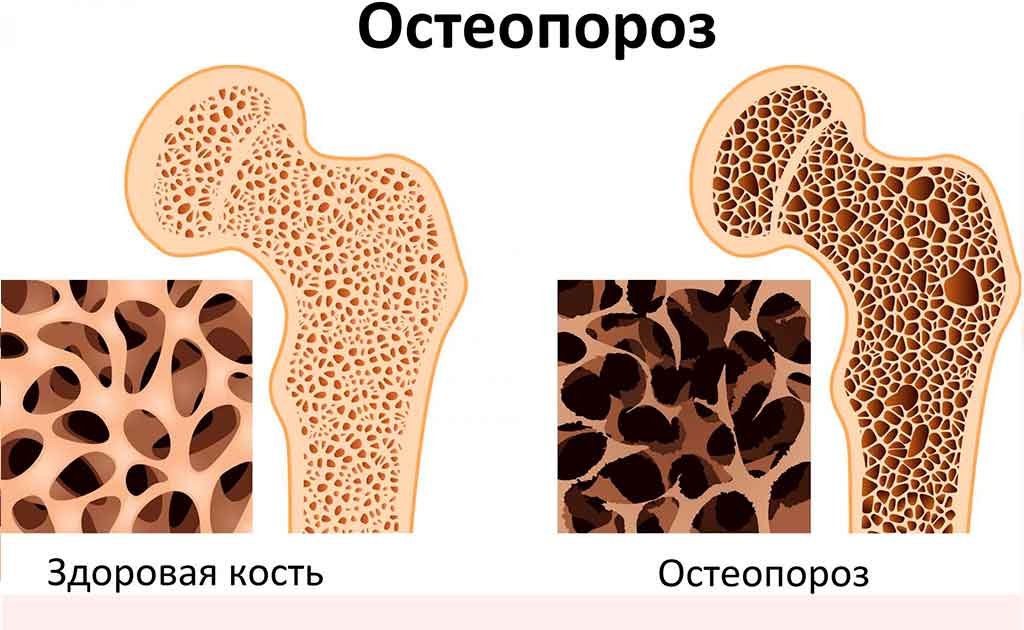 остеопороз