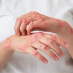 hands-patient-suffering-from-psoriasis